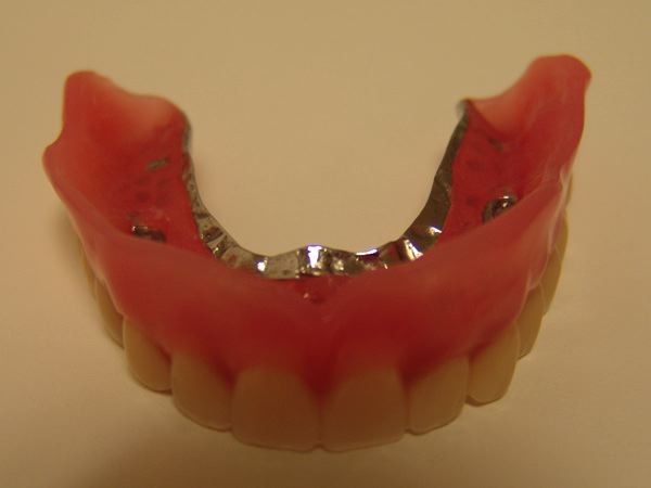 Oberkiefer gaumenplatte zahnprothese ohne Zahnprothese: Teilprothese,